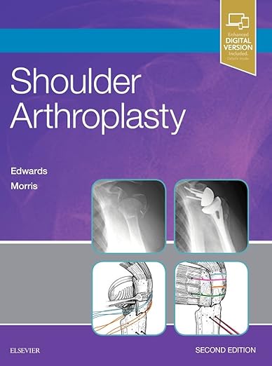 Shoulder Arthroplasty