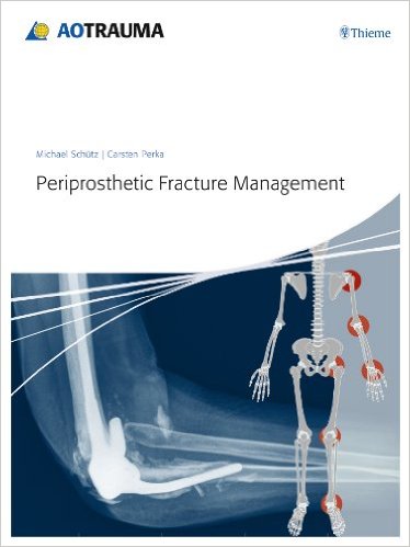 Periprosthetic Fracture Management – Original PDF