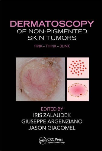 Dermatoscopy of Non-Pigmented Skin Tumors: Pink – Think – Blink – Original PDF