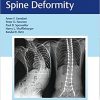 Neuromuscular Spine Deformity-Original PDF