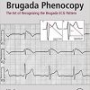 Brugada Phenocopy: The Art of Recognizing the Brugada ECG Pattern-Original PDF