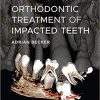 Orthodontic Treatment of Impacted Teeth 4th Edition (without bookmarks)-True PDF