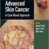 Advanced Skin Cancer: A Case-Based Approach -Original PDF