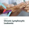 Fast Facts: Chronic Lymphocytic Leukemia -Original PDF