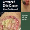 Advanced Skin Cancer: A Case-Based Approach -EPUB