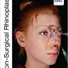 Non-Surgical Rhinoplasty -Original PDF