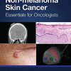 Non-melanoma Skin Cancer: Essentials for Oncologists -Original PDF
