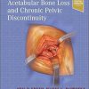Treatment of Acetabular Bone Loss and Chronic Pelvic Discontinuity 1st Edition-True PDF
