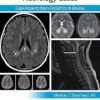 Pediatric Collections: Neurology Cases: Case Reports from Pediatrics in Review -Original PDF