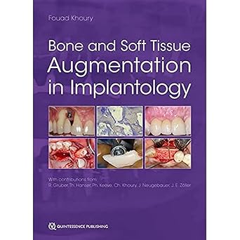 Bone and Soft Tissue Augmentation in Implantology -EPUB