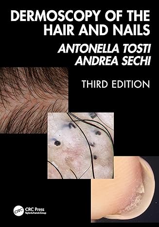 Dermoscopy of the Hair and Nails 3e -EPUB