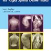 Corrective Osteotomies for Rigid Spinal Deformities -EPUB