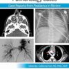Pediatric Collections: Pulmonology Cases: Case Reports from Pediatrics in Review -Original PDF