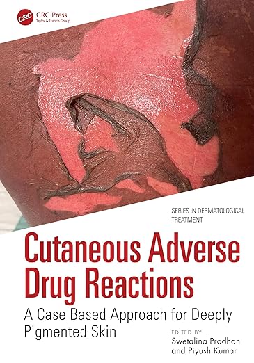 Cutaneous Adverse Drug Reactions: A Case Based Approach for Deeply Pigmented Skin (Series in Dermatological Treatment) -EPUB