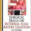 Surgical Skills on Internal Iliac Artery Ligation for Controlling Postpartum and Pelvic Hemorrhage-Original PDF