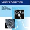 Flow Diversion of Cerebral Aneurysms-EPUB