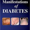 Cutaneous Manifestations of Diabetes-Original PDF