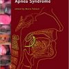 Surgery for Snoring and Obstructive Sleep Apnea-Original PDF