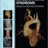 Aneurysms-Osteoarthritis Syndrome: SMAD3 Gene Mutations 1st Edition – Original PDF